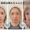 スタッフ自身も実感｜小顔矯正4回目以降も続く変化とお悩みに合わせたメンテナンス