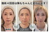 「スタッフ自身も実感｜小顔矯正4回目以降も続く変化とお悩みに合わせたメンテナンス」