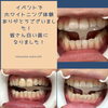aileでホワイトニング「イベントで白い歯GET」