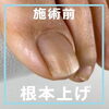 No.50巻き爪上げケア事例３「No.50巻き爪上げケア事例」