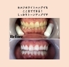 驚く変化！セルフホワイトニングでトーンアップ！ | WHITENING CARE