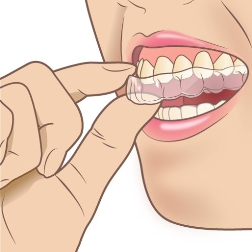 「歯の矯正の種類　#歯の矯正#歯並び#ガタガタ#インビザライン#ワイヤー」