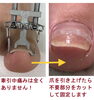 「巻爪ケア1回めでここまで変わる❗️」