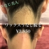 「うなじ1度でスッキリならワックス脱毛がオススメ◎」