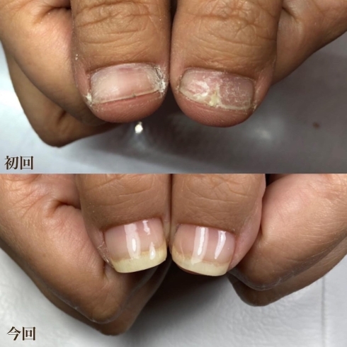 爪のトラブル 割れて生えてくる Nail Anchuにお任せください 府中市若松町 自爪育 深爪緩和ネイルネイルサロン Nail Anchuのニュース まいぷれ 府中市