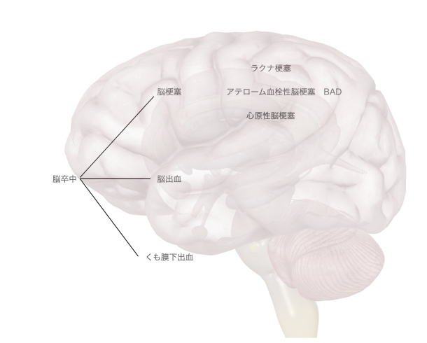 脳卒中「【リハビリ】脳卒中=脳梗塞/脳出血【脳梗塞】」