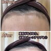 wax脱毛でツルスベお肌に☆【千歳フェイシャルスキンケアサロン/千歳フェイシャルエステサロン/大口式ドライヘッドスパ/スキンケアwax脱毛/VOS正規取扱サロン/VOSサロンケア】