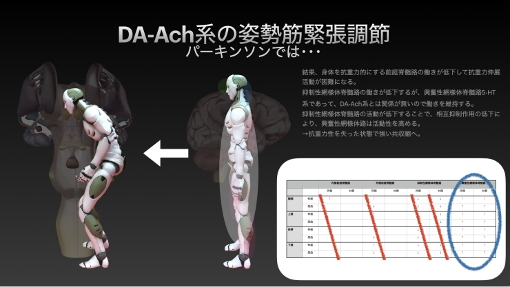 パーキンソン病の姿勢制御「【脳卒中/脳性小児麻痺】パーキンソン病【リハビリ】」