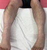むくんだ両足の写真「【脳卒中/脳性小児麻痺】身体図式と浮腫【リハビリ】」