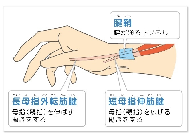 「施術紹介：ドゥ . ケルバン病（狭窄性腱鞘炎）」