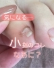 「【フットネイル】フットケア　小指の気になるこれ何？」