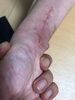 術後の手、浮腫が減ってシワが出たところ「骨折後のリハビリテーション」