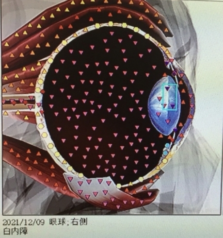 白内障の波動エネルギー「【白内障の波動エネルギーの状態とは】メタトロン波動測定でお客様に起こった事 メタトロン鳥取　米子　鳥取氣功院」