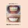 セルフホワイトニング before afterです！！！ | WHITENING CARE（ホワイトニングケア）のニュース | まいぷれ[新居浜市]