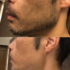 Before＆After　志木　朝霞台　メンズ脱毛☆