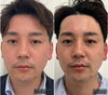 ラジオ波とEMSで両頬もすっきり「フェイスラインすっきりで若返り【福井市エステ/ハイフ/男性フェイシャル/男性フェイシャルエステ】」