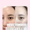 ニキビやシミに悩まない美肌へ◎【福井春江 / ハーブピーリング / 毛穴洗浄 / 美肌ワックス】