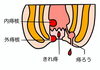 「【センター北のうんち薬局 漢方ハタ薬局】〜痔ろう（あな痔） 〜 下痢 ・便秘・腰痛・膝痛・ 神経痛・自律神経・睡眠・後鼻漏 漢方相談 横浜都筑」