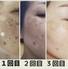 あなたの気になるシミ、取ります！！】人気メニュー シミデトックス 