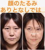 「【たるみ・シワ】改善への近道ありますよ！若返る喜びを実感ください♪」