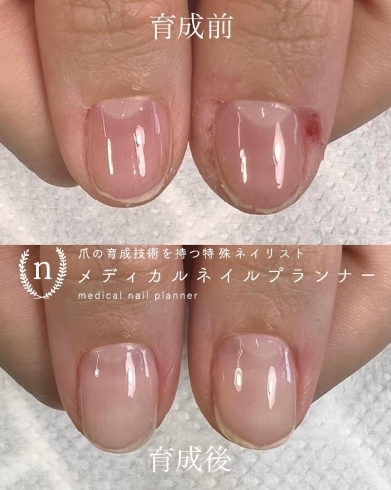 自爪育成 育成後どこまで伸びる Nail Melia Medical Healthcare のニュース まいぷれ 福井 自爪育成 育成後どこまで伸びる Nail Melia Medical Healthcare のニュース まいぷれ 福井