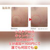 シミ撃退「シミ打ち放題10分3850円」
