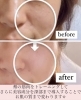 「頬のたるみ,ほうれい線もピーン！お肌のハリまでも取り戻せます【福井市エステ】」