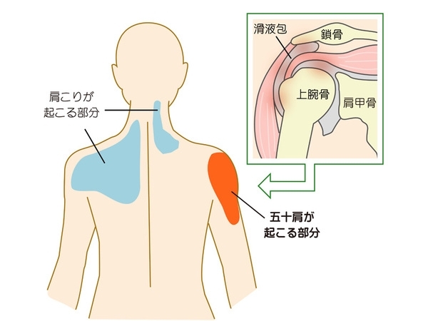 「「川口前川Eve整骨院」この症状は五十肩かも？」