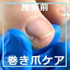 陥入爪施術事例No.86ー３「痛くて角を伸ばせなかったお爪をきれいに補正　陥入爪施術事例No.86」