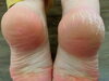 使用前・使用後「かかとのカサカサ気になりますか？」