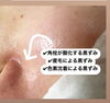 「角栓と毛!!!」