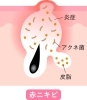 「ニキビを皮膚科で治すメリットは？」