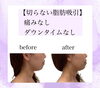 「1時間でフェイスラインすっきりさせます！【福井市/エステ/ハイフ/フェイスライン/小顔】」