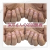 「深爪さんの初回施術はこんな感じ！【福井/深爪育成】」