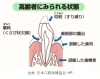 予防と元気を掲げる高蔵寺のフェアリ歯科「高齢者に見られる歯の状態　　予防と元気を掲げる高蔵寺のフェアリ歯科」
