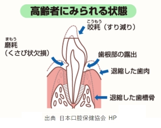 予防と元気を掲げる高蔵寺のフェアリ歯科「高齢者に見られる歯の状態　　予防と元気を掲げる高蔵寺のフェアリ歯科」