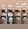 クールスカルプティング® エリート（クルスカダブル