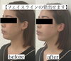 理想のフェイスライン造れます「ハイフで骨出せます【ハイフ/フェイシャルエステ/小顔/むくみ解消/リフトアップ】」