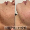 ハードで肌質改善！【 福井市 / エステ / ハードトリートメント / ハーブピーリング / 剥離あり / ニキビ /  ニキビ跡  】
