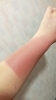 日焼けしてしまいましたので実験します「日焼けしてしまった(T^T) リンパトリートメント店 妃～プリンセス～」