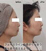 「ハイフをすると首まで長く見えるように【福井エステ/福井ハイフ/小顔/メンズフェイシャル/リフトアップ】」