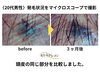頭皮のビフォーアフター「マイクロスコープから見た発毛状況の紹介」