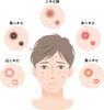 いろいろなニキビ「ニキビで困ったら、皮膚科で相談しましょう」