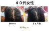 ※効果には個人差があります。「凄い勢いです!施術2回で発毛効果を実感!」