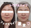 「ハイフモニター募集中◎8月末まで《 残り…２ヶ月 》【 福井 / 福井市 / ハイフ / トリプルハイフ / フェイスライン / 小顔 / たるみ / むくみ   】」