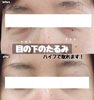 「目の下のたるみもお任せください【福井市エステ/目元若返り/福井市ハイフ/小顔/メンズフェイシャル】」