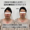 男性にも大人気です「男性もハイフで理想のフェイスラインへ【福井市エステ/福井市ハイフ/福井フェイスエステ/福井メンズフェイシャルエステ】」