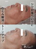 「くすみが消えて若々しい肌に【 福井 / 福井市 / エステ / ハーブピーリング / くすみ / 毛穴 / トーンアップ / シワ / 美肌 / 美肌管理 】」