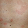 カラダに多発する赤くて丸い斑点は水虫かもー皮膚科で診察を！