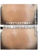 「小顔と美肌が同時に叶っちゃう！【 福井 / 福井市 / ラジオ波 / EMS / ポレーション / リフトアップ /血行促進 /美肌 】」